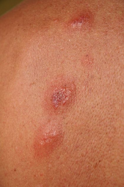 Flea Bites on Humans - Pictures, Symptoms and Treatment