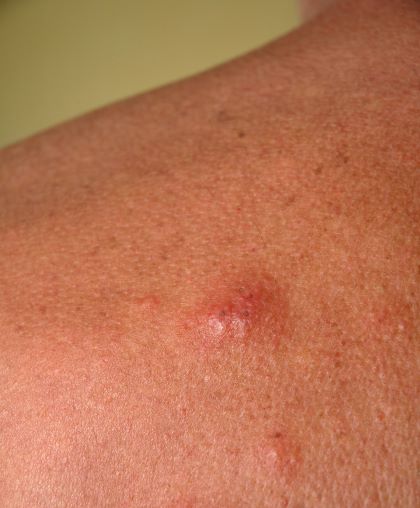 Close-up of a puncture wound and a reaction to a dog flea bite on human skin.